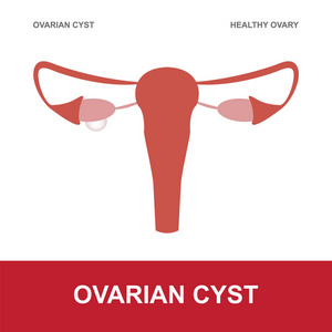 健康的卵巢和 oviarian 囊肿