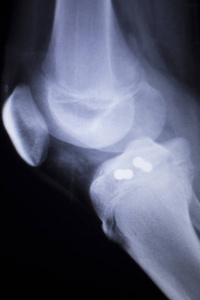 膝关节植入 x 射线
