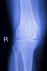 膝关节植入 x 射线