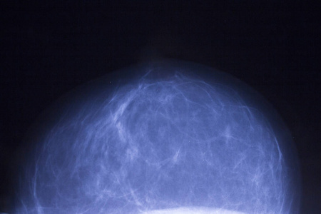 乳腺肿瘤的 x 线