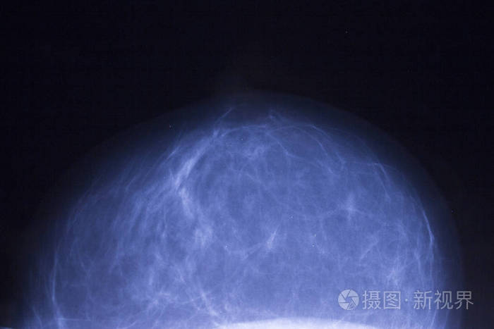 乳腺肿瘤的 x 线
