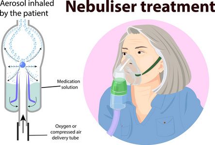 雾化器治疗解剖学的矢量插图