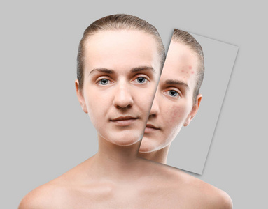 痤疮和护肤理念。 年轻女子化妆前后的灰色背景