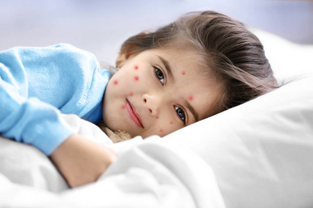 小女孩长着红色的粉刺躺在家里的床上。 水痘概念