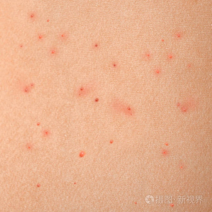 纹理的皮肤,红色的丘疹