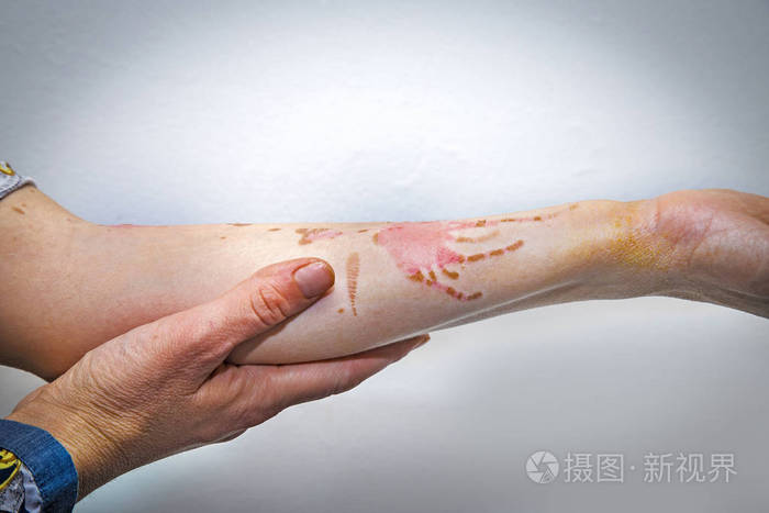 高锰酸钾灼伤皮肤表现图片