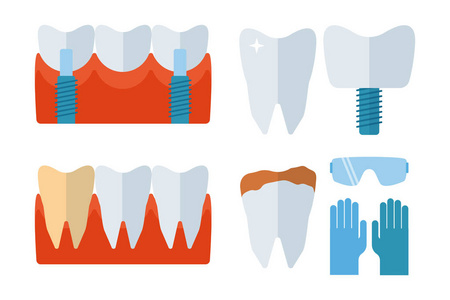 牙医牙齿植入物和口腔科设备矢量图