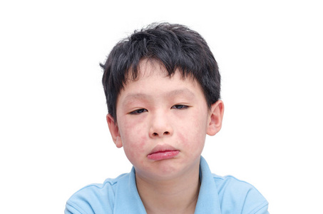 年轻的亚洲儿童脸在白色背景下有皮疹