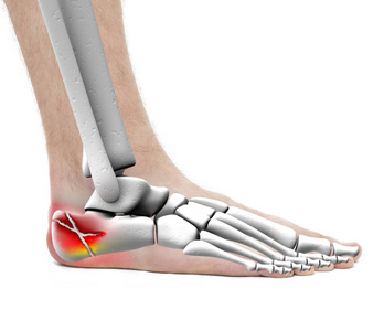 腿跟骨折或骨折的儿童坐在里面用石膏绷带车坏了骨头,脚踝骨折.