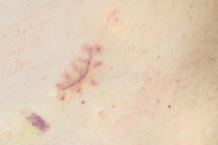 男性背部新伤疤特写.照片