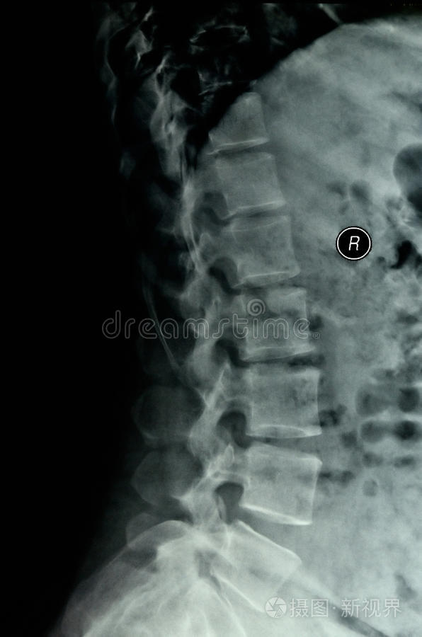 腰椎侧位x线片