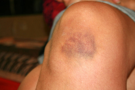 淤青图片-淤青素材-淤青插画-摄图新视界