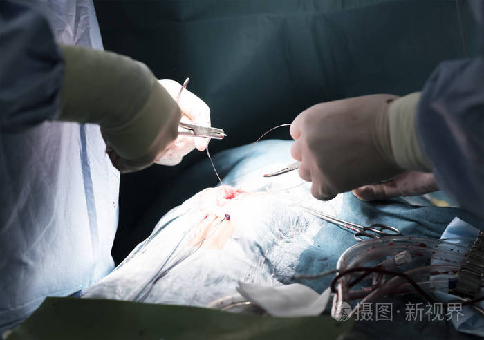 外科医生在无菌手套针夹紧缝合的伤口