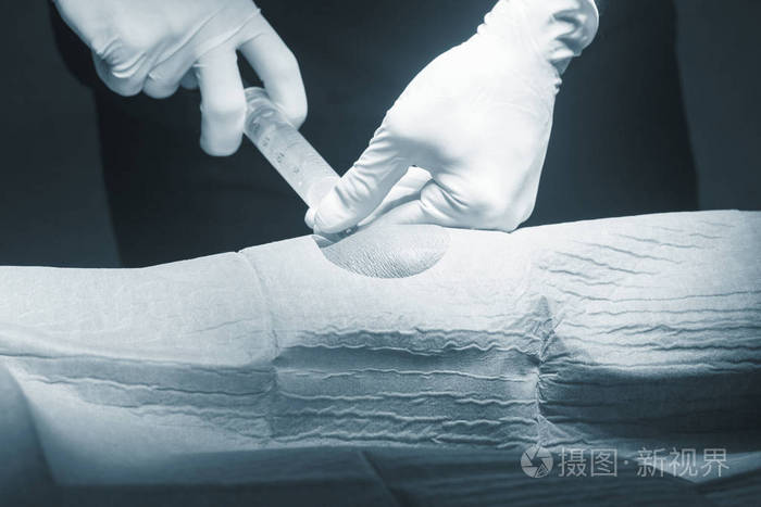 膝关节手术麻醉注射