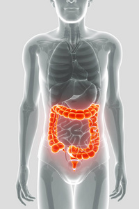 大肠癌的 3d 渲染照片