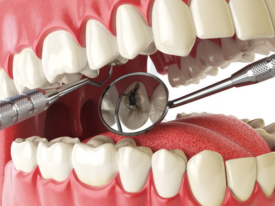 Cariesand 孔与工具的人类牙齿。牙科搜索浓