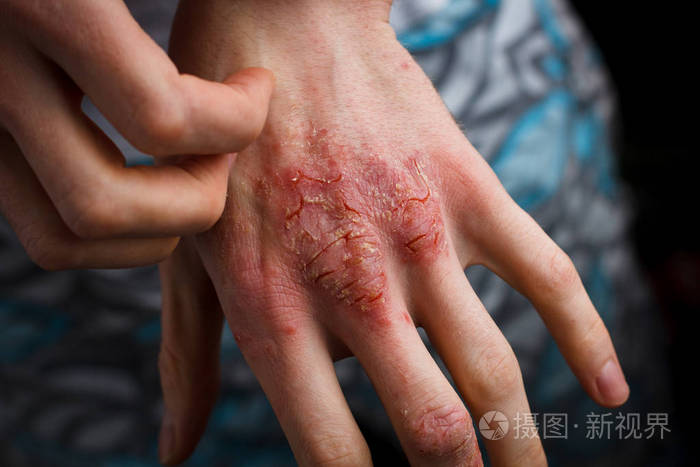 应用的润肤使干燥的片状皮肤在治疗银屑病, 湿疹和其他皮肤干燥条件