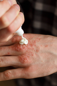 儿童干性湿疹图片