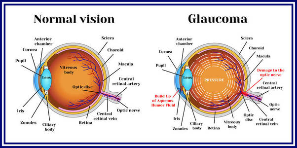 正常视力。青光眼
