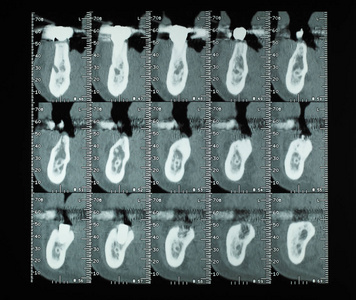 CT扫描又称猫扫描横断面层析图像x人牙骨射线