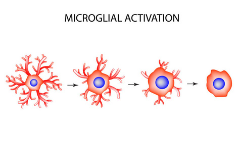 活化的小胶质细胞。神经元。神经细胞。信息图表。对孤立背景矢量图