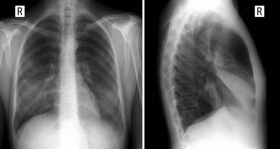 X 射线肺。显示右肺中叶大的渗透。肺炎。前面和侧面投影