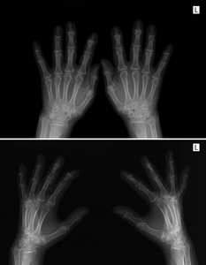 X 射线的手。关节炎关节病
