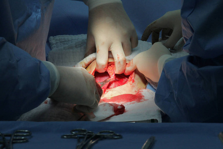 剖腹产过程新婴儿诞生在手术室经典剖宫产时照片