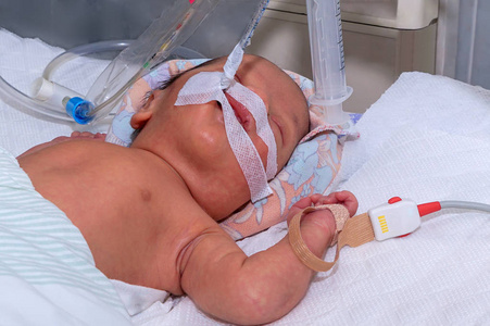新生儿高胆红素血症对与脉搏血氧仪传感器在儿童医院新生儿重症监护病房呼吸机