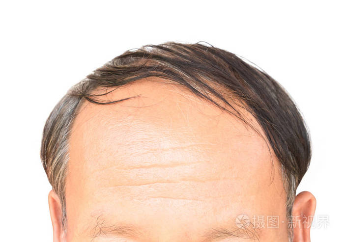 老人严重脱发问题为卫生保健的洗发水和美容产品概念照片-正版商用图