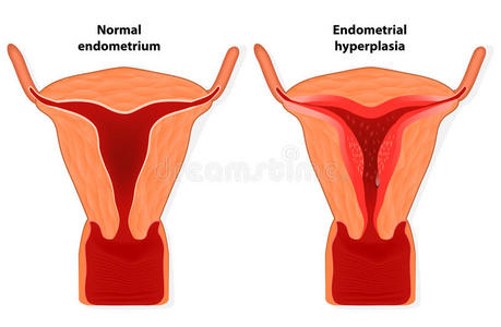 子宫内膜增生图片