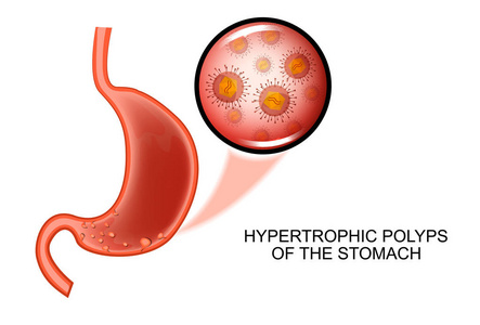 胃增生性息肉病