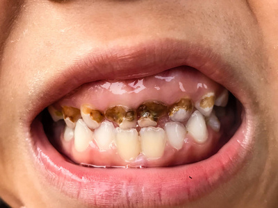 牙齿腐烂预防图片