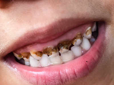 牙齿破损和腐烂的小孩照片