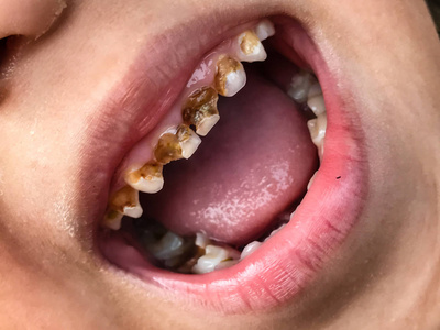 牙齿破损和腐烂的小孩照片