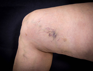 腿部水肿图片-腿部水肿素材-腿部水肿插画-摄图新视界