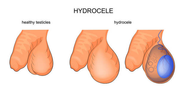 鞘膜积液.泌尿外科照片