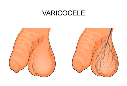 精索静脉曲张的阴囊图图片