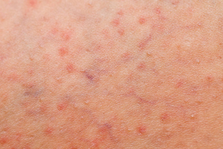 毛囊虫皮炎图片