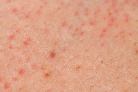 毛囊虫皮炎图片