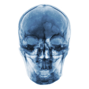 X 光胶片的正常人类的头颅骨。前视图