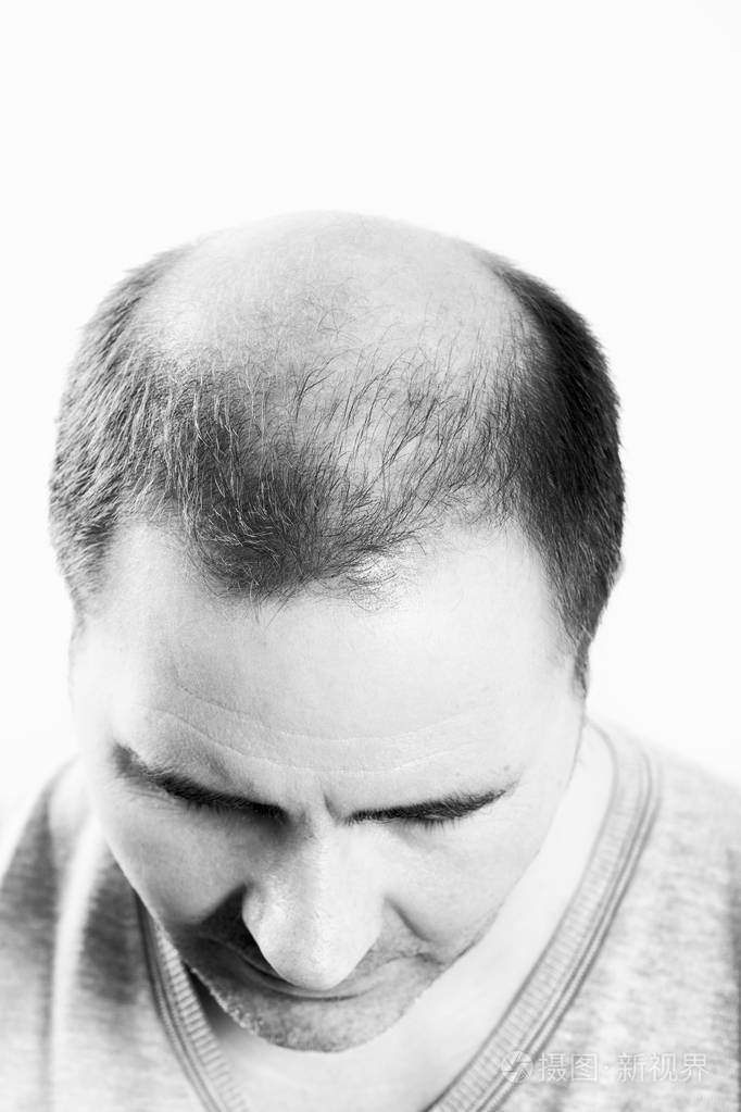 中年男子关注脱发秃发脱发孤立