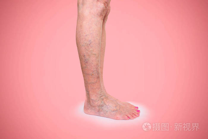 在女性的腿上静脉曲张