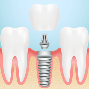 现实健康的牙齿和牙科植入物。安装的所有部分冠，桥台，孤立在背景上的螺丝牙种植体。矢量图