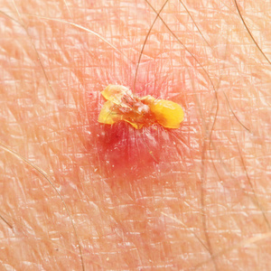 咬痕 刺痛或人体皮肤上的疮口有血的伤口.咬一口.夏天有蚊子.