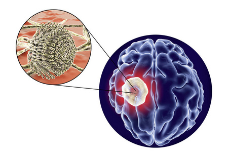 曲菌球病的真菌曲霉大脑和特写视图