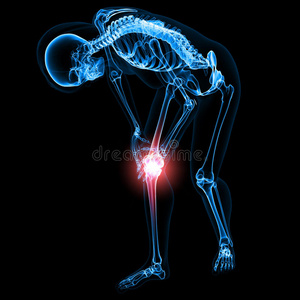 女性骨骼伴膝痛