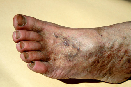 血栓 形成.脚.腿部静脉的延伸照片