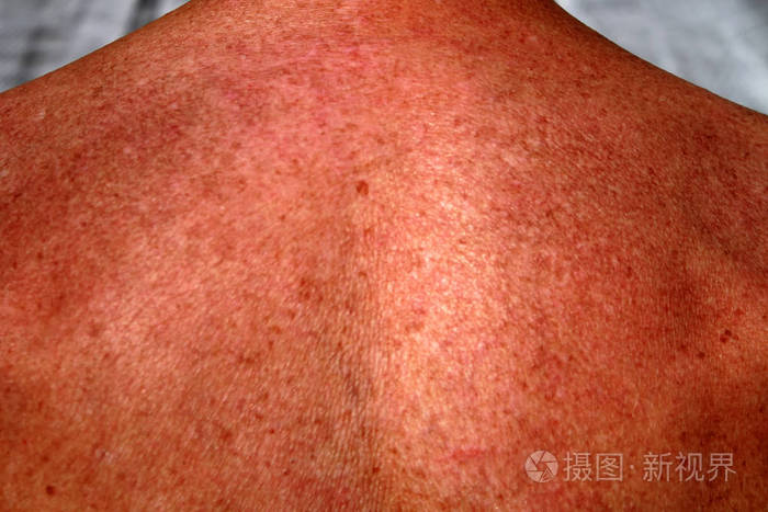 肩部和背部的色素沉着棕色皮肤有斑点雀斑