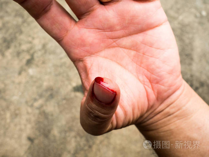 左手的拇指血流量造成的估计不应谨慎修复管道